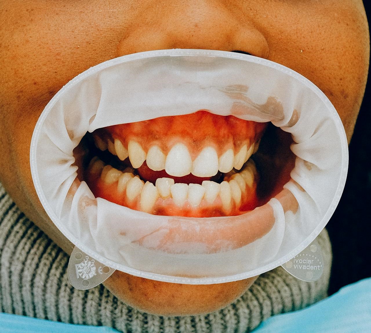 Qu’est-ce qu’une dent incluse ?